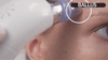 Blackhead Remover Vacuum — Pore Cleansing Suction Tool
